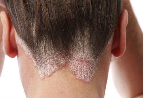 Mătreața și seboreea – remedii naturale Mătreața și seboreea – remedii naturale