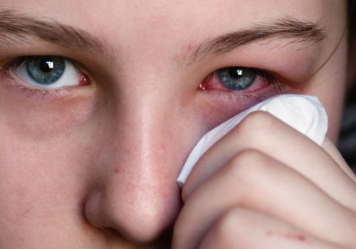 Anumite alergii pot cauza ochii roșii
