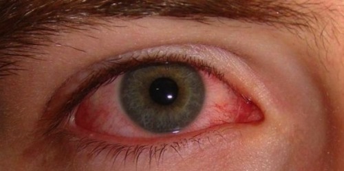 Ochii roșii - ce remedii naturale există?