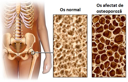 osteoporoza Osteoporoza este o afecțiune foarte periculoasă