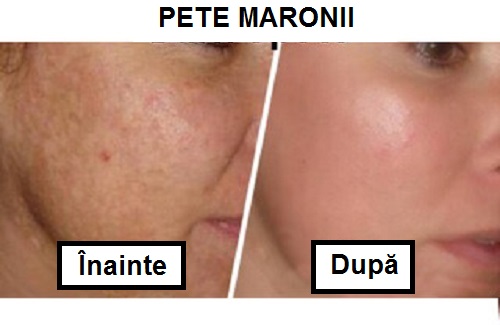 Tratament cu oțet de mere pentru pete maronii