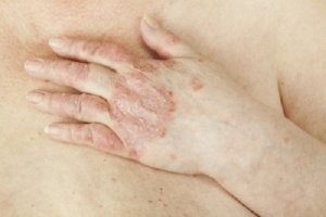 Vindecarea psoriazisului este posibilă?
