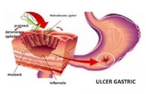 6 remedii naturiste pentru Helicobacter pylori