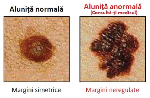 Simptome ale cancerului precum apariția de alunițe anormale