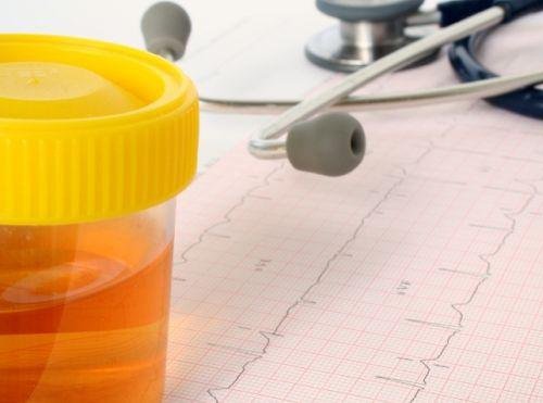 Simptome ale cancerului precum schimbarea de culoare a urinei