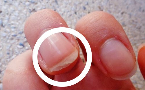 exfolierea unghiilor din cauza ciupercii care bat ciuperca unghiilor