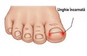 Unghiile crescute în carne: metode de prevenire