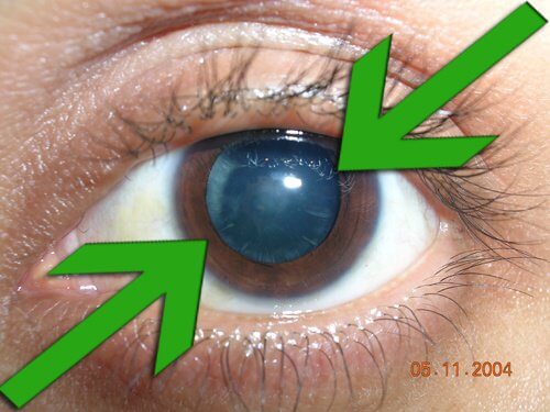 Vederea afectată de cataractă