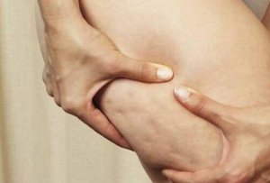 7 alimente care provoacă celulită