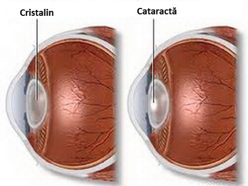 Cataracta se manifestă printr-un "voal lăptos" care acoperă cristalinul