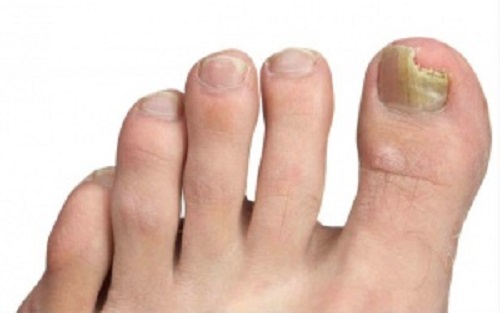 ciuperca unghiilor de la picioare trăiește sănătos