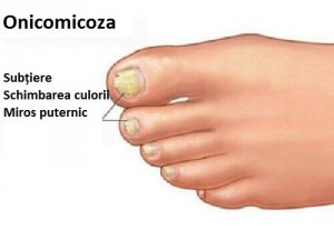 tratează eficient ciuperca unghiilor de la picioare)