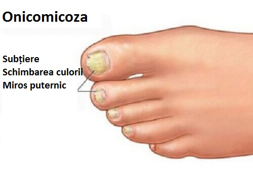 ciuperca unghiei de la picioare tratament gudron de mesteacan