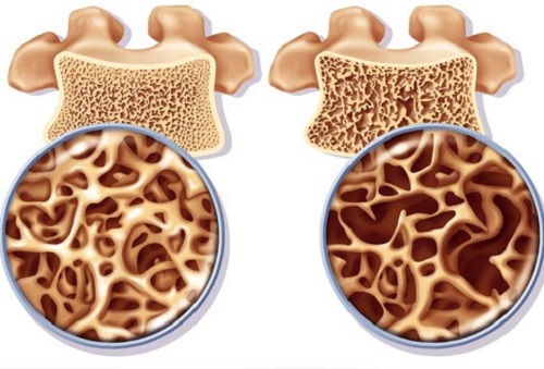 Calciul previne osteoporoza la menopauză