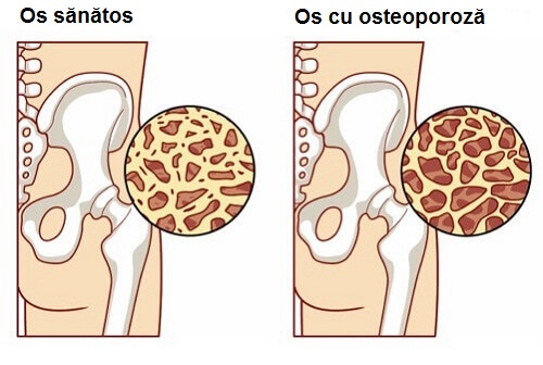 Alimente care reduc riscul de osteoporoză