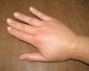 Ceaiuri care combat simptomele retenției de apă
