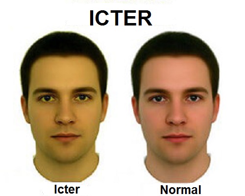Bărbat care prezintă icter