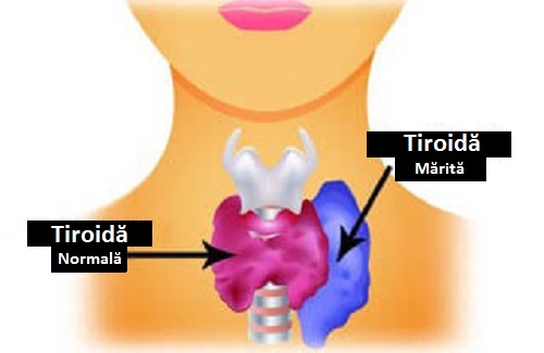 Hipertiroidismul este una dintre principalele disfuncții ale tiroidei