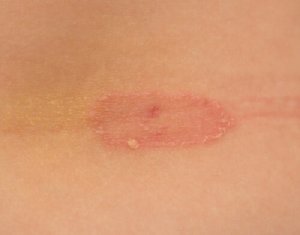 Micoza piciorului și prevenirea acesteia