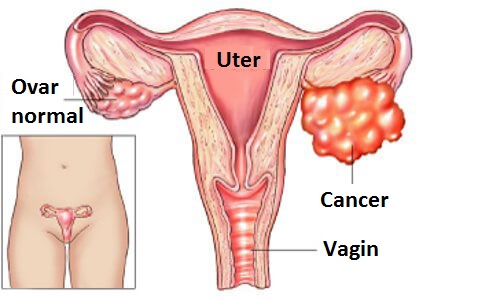 Dacă nu ai grijă de tine, poți dezvolta boli de ovare