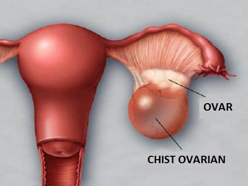 5 factori care produc boli ovariene