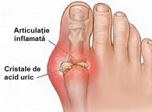 Riscurile și prevenirea acumulării de acid uric