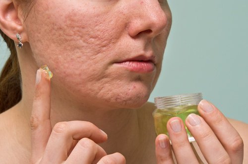 10 remedii naturale pentru tratarea acneei