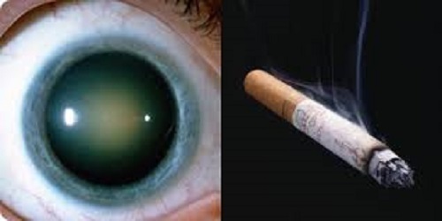 Nevoia de remedii naturiste pentru cataractă pentru fumători
