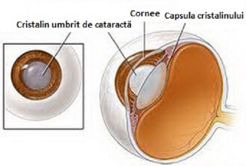Nevoia de remedii naturiste pentru cataractă