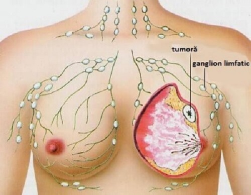 5 tipuri comune de cancer la femei