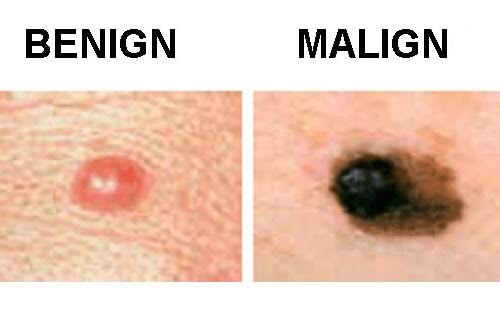 Tipuri comune de cancer precum cel de piele