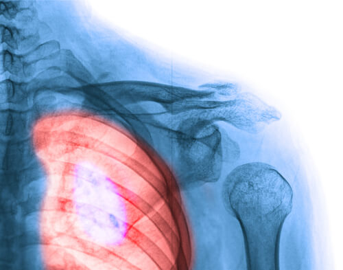 Tipuri comune de cancer precum cancerul pulmonar