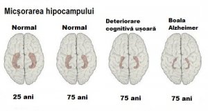 Semnele timpurii ale Alzheimerului