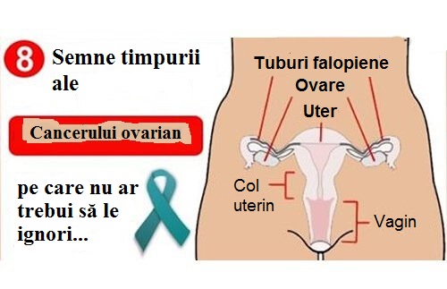 Cancerul ovarian este un tip de cancer ginecologic