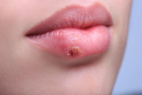 Cauzele reapariției herpesului oral