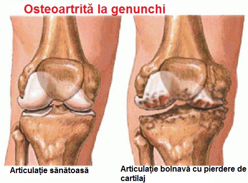 Durerile articulare pot fi localizate la genunchi