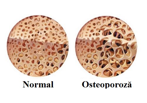 Durerile de oase pot fi cauzate de osteoporoză