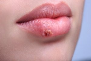 sfaturi anti-imbatranire de la vedete cu herpes