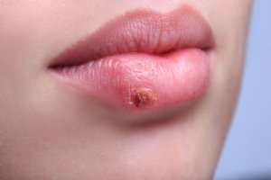 Herpesul: prevenire și tratamente naturale