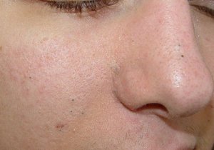 Puncte negre, negi, pete: remedii naturale