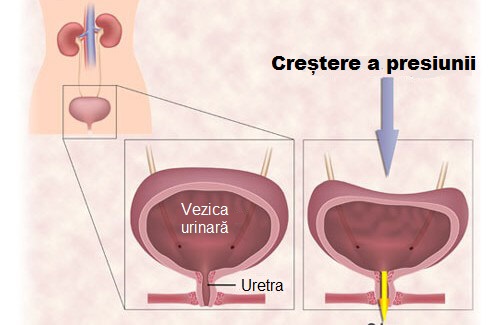 Remedii pentru incontinența urinară și cauzele acesteia