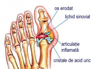 Sfaturi și remedii naturale pentru gută