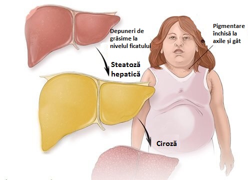 Trebuie să tratăm steatoza hepatică începând cu micul dejun