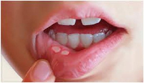 Aftele bucale: cauze și remedii naturale
