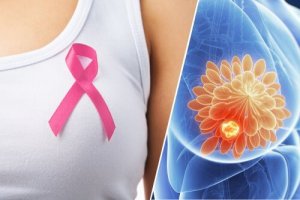 Simptome timpurii de cancer mamar