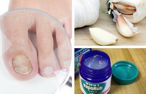 restaurare fungică a unghiilor)