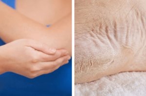 Pielea uscată de pe coate și tălpi: remedii