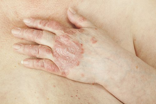 Psoriazisul este printre posibilele cauze ale mâncărimilor vaginale
