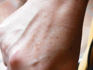 Remedii naturale pentru pistrui și utilizarea lor