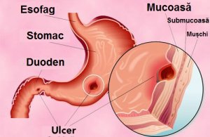 Remedii pentru ulcerul gastroduodenal